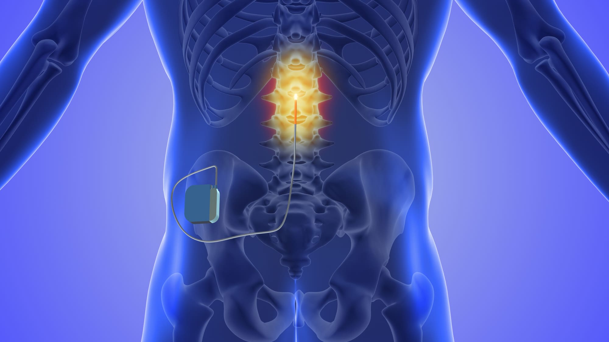 Spine pain management in Broward County
